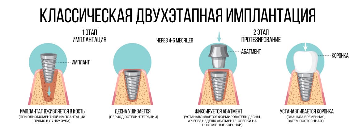 vidy implantacii